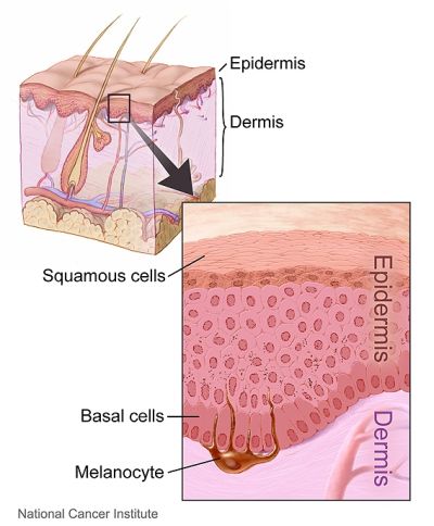 Basal cell carcinoma diagram
