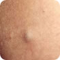 Epidermal Cyst