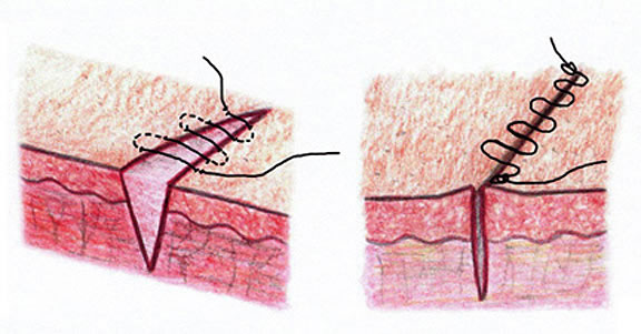 Diagram of invisible stitching technique