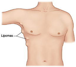 Lipoma Diagram