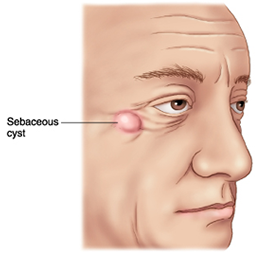 Sebacceous Cysts