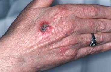 Squamous cell carcinoma